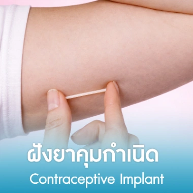 ฝังยาคุมกำเนิด 