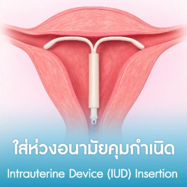 ใส่ห่วงอนามัยคุมกำเนิด 