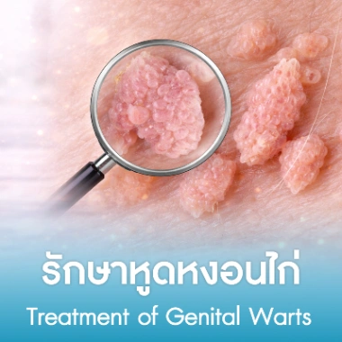 รักษาหูดหงอนไก่