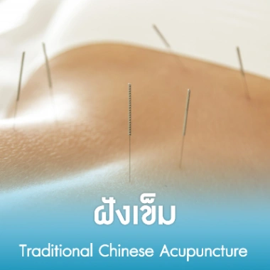 ฝังเข็ม