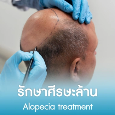 รักษาศีรษะล้าน