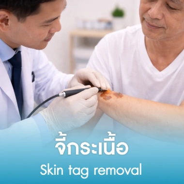 จี้กระเนื้อ