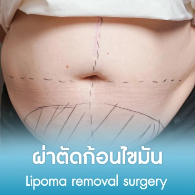 ผ่าตัดก้อนไขมัน