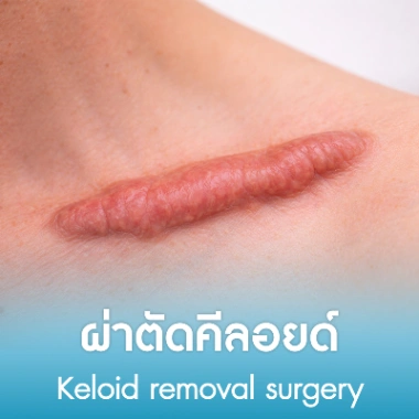 ผ่าตัดคีลอยด์