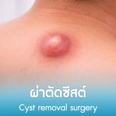 ผ่าตัดซีสต์
