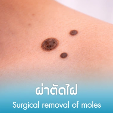 ผ่าตัดไฝ